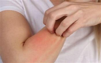   احمرار في الجلد أبرزها.. أعراض خطيرة للحمى الروماتيزمية