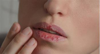   أسباب جفاف الفم وأعراضه وعلاجه 