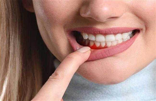 دراسة علمية تؤكد علاج التهاب اللثة بالأعشاب