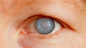   الجلوكوما.. مرض خطير يتلف العصب البصري