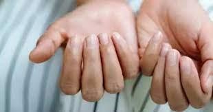   أعراض على أطراف الأصابع دليل إصابتك بسرطان مميت