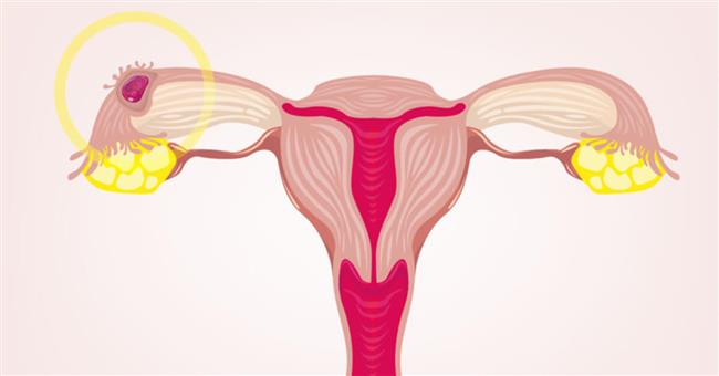 اعراض الحمل خارج الرحم وكيفية التعامل معها