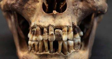 دراسة: إجراء تقويم أسنان فى القرن الـ17 لحماية إبتسامة النخبة فى فرنسا