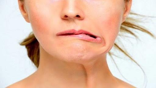 تعرف على اعراض التهاب العصب السابع