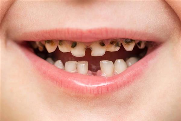 أبرز أسباب تسوس الأسنان عند الأطفال