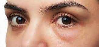   لعلاج الانتفاخات حول العينين.. 5 وصفات لزيوت طبيعية