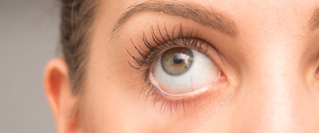 طرق طبيعية لعلاج مشكلة جفاف العيون