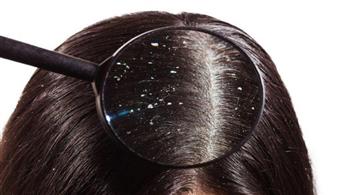   كيف تتغلب على قشرة الشعر المستمرة؟