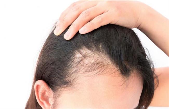 3 وصفات طبيعية لعلاج فراغات الرأس ..تعرّفى عليها 