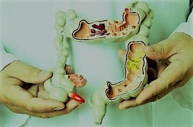 التهاب الرتج ..تعرف على ابرز مضاعفات 