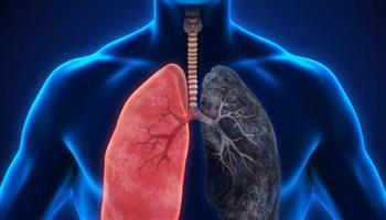 مرض الانسداد الرئوى المزمن . . اعراض وأسباب وعلاج