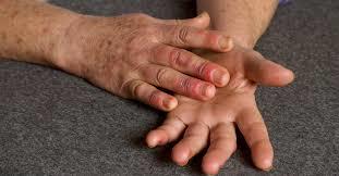 برودة أطراف اليدين والقدمين.. هذه أبرز أعراض مرض رينود