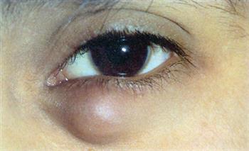   أفضل 6 طرق طبيعية لعلاج الاكياس الدهنية في عيون الأطفال