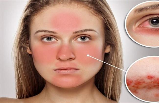 تعرف على أبرز أعراض الذئبة الحمراء