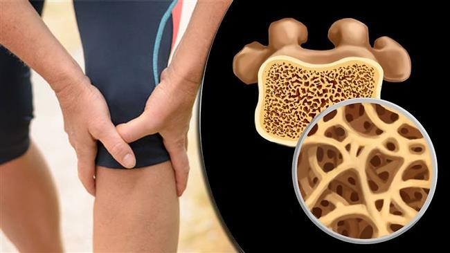 احذروا.. هشاشة العظام مرض اللص الصامت وهذه أبرز أعراضه وطرق علاجه