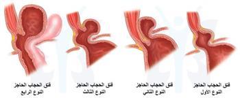 تعرف على اسباب وأعراض فتق الحجاب الحاجز