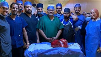   فريق طبي بجامعة أسيوط ينقذ سيدة من ورم وزنه 30 كيلو