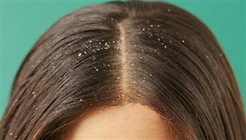   بدون تكلفة.. هاني الناظر يكشف عن حل سحري للقضاء على قشرة الشعر