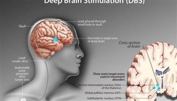   دراسة أمريكية: تقنية التحفيز العميق للدماغ قد تساعد في علاج السكتات الدماغية