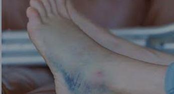   دراسة جديدة: وجود زرقان فى القدم قد يكون مرتبطا بأعراض طويلة المدى بكورونا