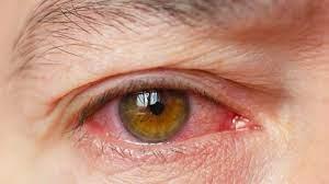   متلازمة جفاف العين.. تعرف على أعراض وأسباب وطرق الوقاية منها