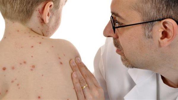 مركز السيطرة على الأمراض يحذر من تفشي جديد لفيروس الحصبة
