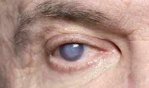 نصائح مهمة لمرضى السكر لتجنب فقدان البصر