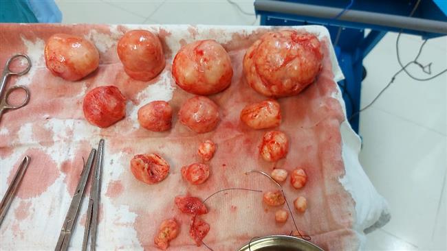 فريق طبي ينجح في استئصال ٢٠ ورما ليفيا من رحم فتاة بميت غمر