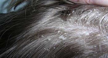   وصفة سحرية للقضاء على قشرة الشعر نهائيا