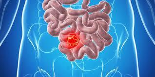 دراسة تكشف: أسباب ارتفاع معدلات سرطان القولون بين الشباب