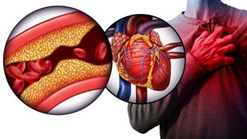   "الصحة العالمية": أمراض القلب والأوعية الدموية تقتل 10 آلاف شخص يوميًا