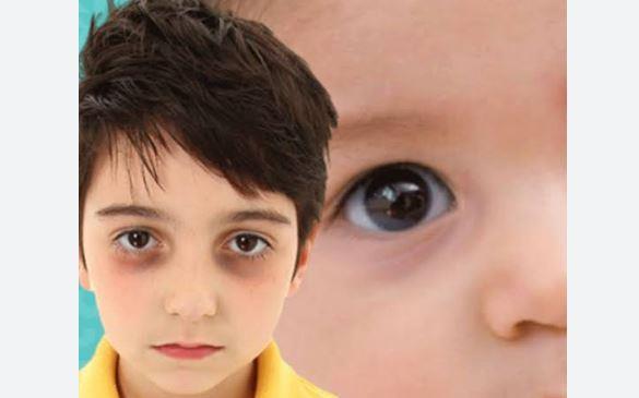 أسباب الهالات السوداء عند الأطفال 