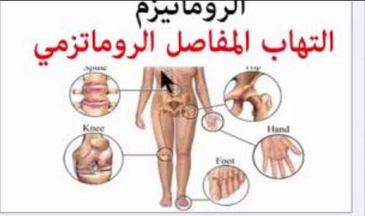 نتائج جديدة يقدمها المؤتمر الأوروبي لعلاج أمراض الروماتيزم في فيينا