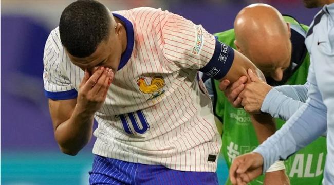 مدرب فرنسا: مبابي بحاجة لإجراء جراحة في أنفه 