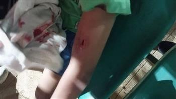   إصابة طفل بجروح إثر هجوم كلب مسعور عليه بجامعة أسيوط
