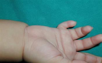 حكاية طفل هندي يولد بـ 25 إصبعًا