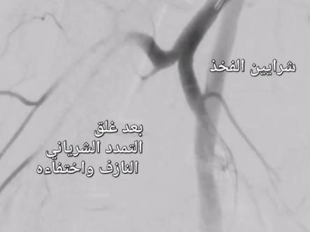 إنجاز طبي جديد لعلاج شرايين "الفخذ النازفه" بمستشفي سوهاج الجامعي