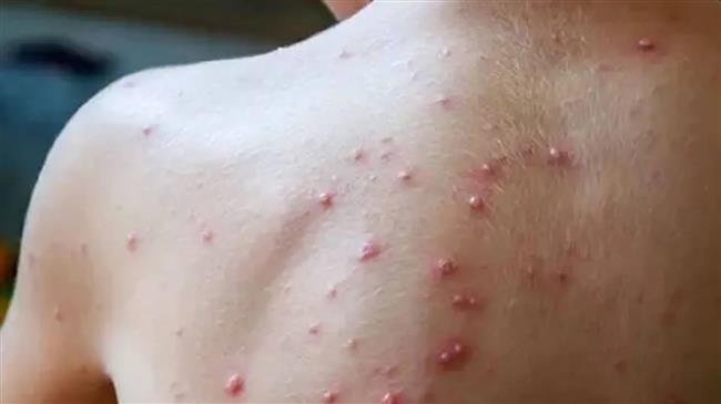 سيراليون تعلن حالة الطوارئ الصحية لمواجهة جدري القردة