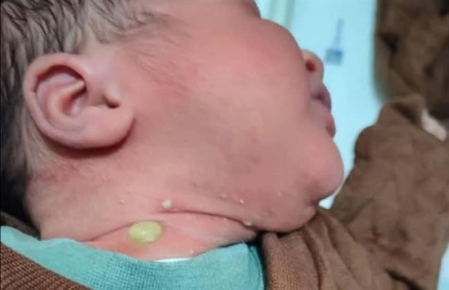 لا داعي للذعر.. علامات جلدية شائعة لدى حديثي الولادة