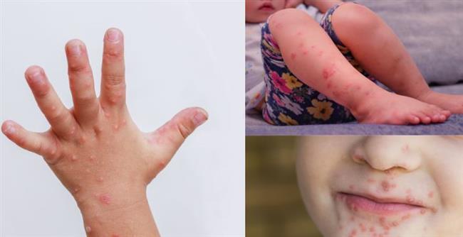 الصحة: فيروس HFMD شائع ويشفى تلقائيا دون أي تدخل طبي 