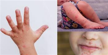   الصحة: فيروس HFMD شائع ويشفى تلقائيا دون أي تدخل طبي 