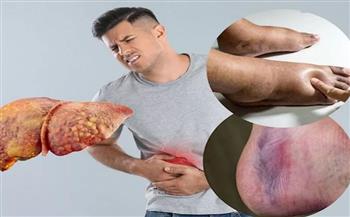   من مطبخك.. خضروات طبيعية تساعد في علاج الكبد الدهني