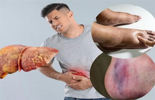 من مطبخك.. خضروات طبيعية تساعد في علاج الكبد الدهني