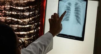   سرطان الرئة : أعراض مبكرة قد تنقذ حياتك