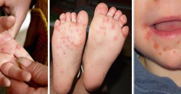 علاج تلقائي.. 5 أعراض لفيروس HFMD على أطفال المدارس
