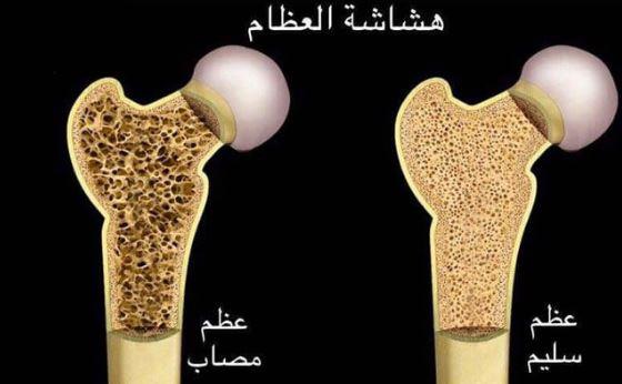 اليوم العالمي لهشاشة العظام: وقايةٌ مبكرةٌ من "اللص الصامت"