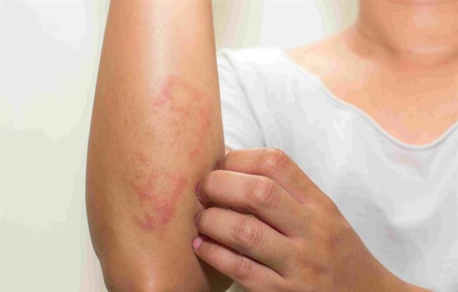 الحكة الجلدية عند مرضى الأكزيما: الأسباب وآلية حدوثها وكيفية التعامل معها
