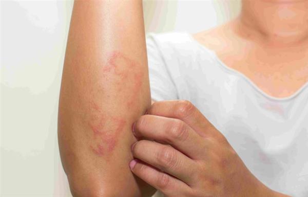 الحكة الجلدية عند مرضى الأكزيما: الأسباب وآلية حدوثها وكيفية التعامل معها