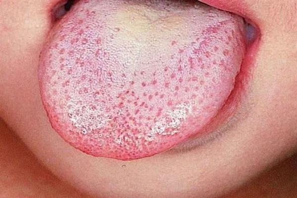 فطريات اللسان يمكن علاجها بخطوات بسيطة