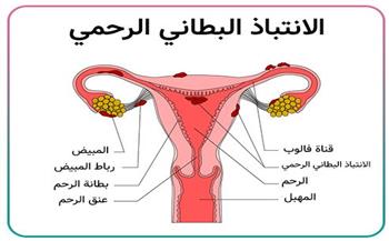   الانتباذ البطاني الرحمي.. ألم صامت يهدد خصوبة النساء